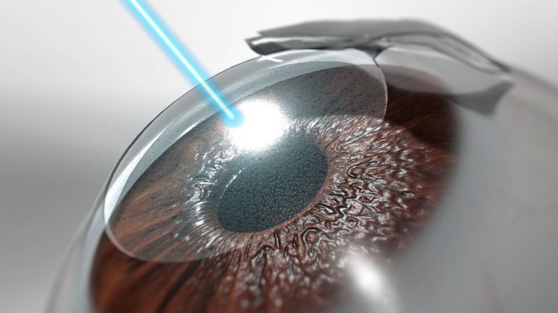 Lasik Surgery What To Expect Before During And After The Procedure