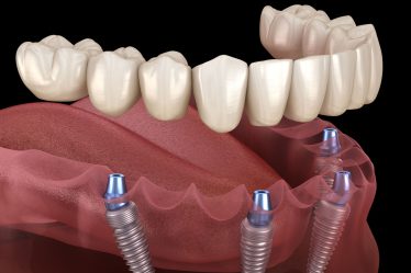 Why Dental Implants Are a Popular Choice in Melbourne