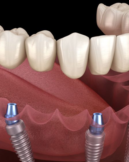 Why Dental Implants Are a Popular Choice in Melbourne